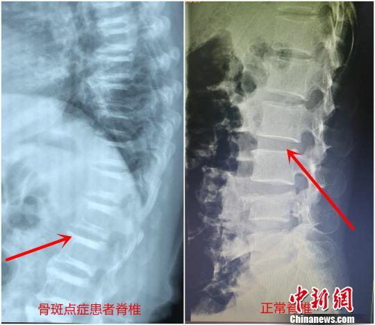 罕见“硬骨头”患者遇骨折手术固定堪比在岩石上打洞